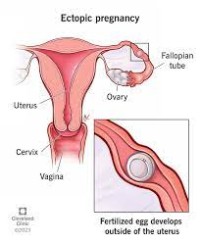 Ectopic Pregnancy