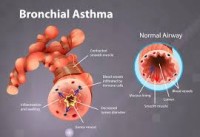 Image of Bronchial Asthma