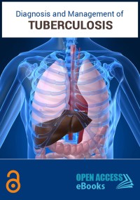 Diagnosis & Management of Tuberculosis