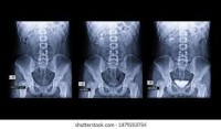 X-Ray Contrast Media