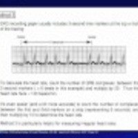 The Normal Electrocardiogram